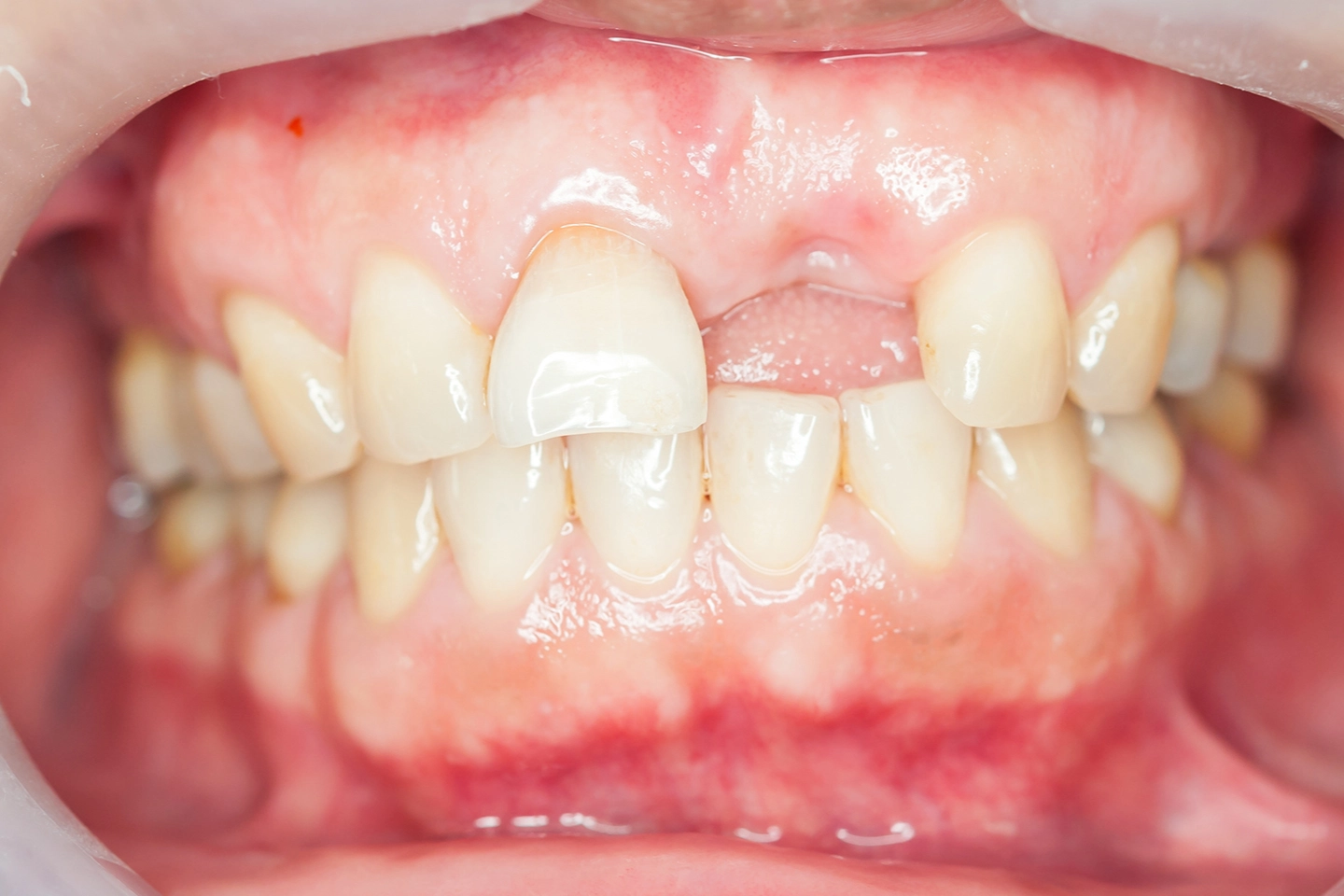 Will I Need a Bone Graft for Dental Implants