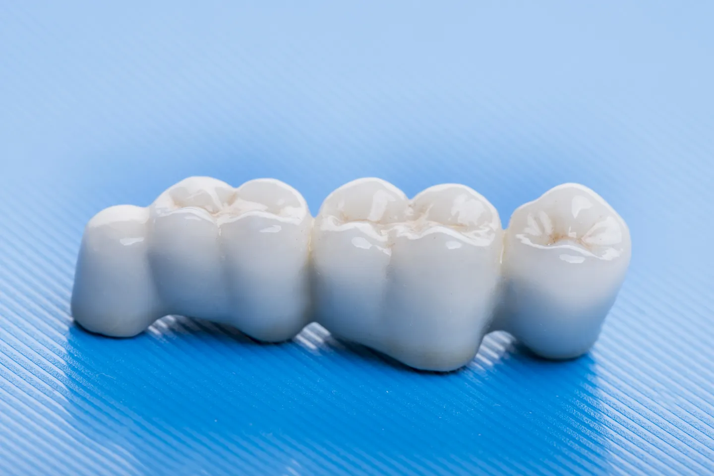 Dental Bridges