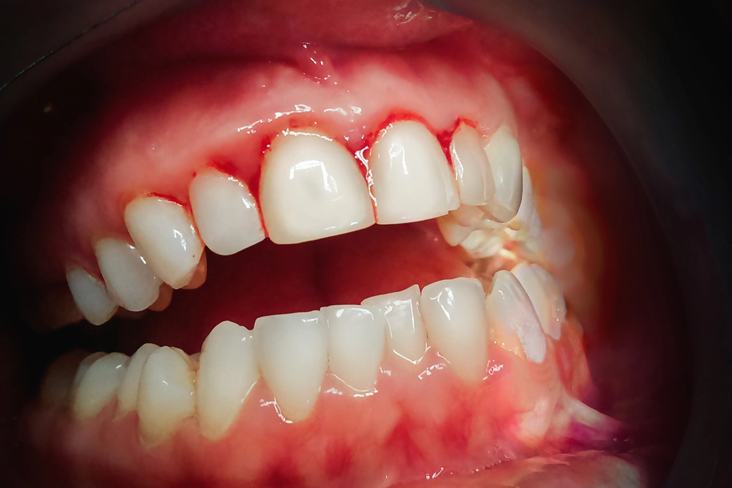 Dental Cleaning and Examinations