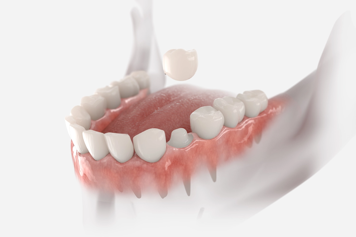 Dental Crowns