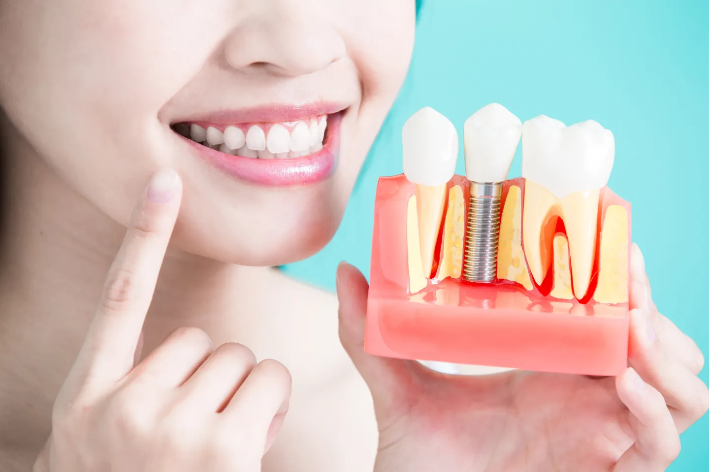 Dental Implant Procedure