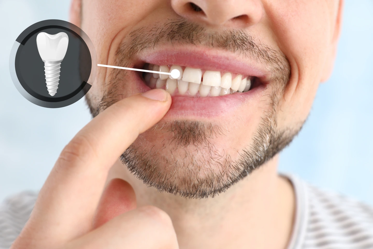 Dental Implants