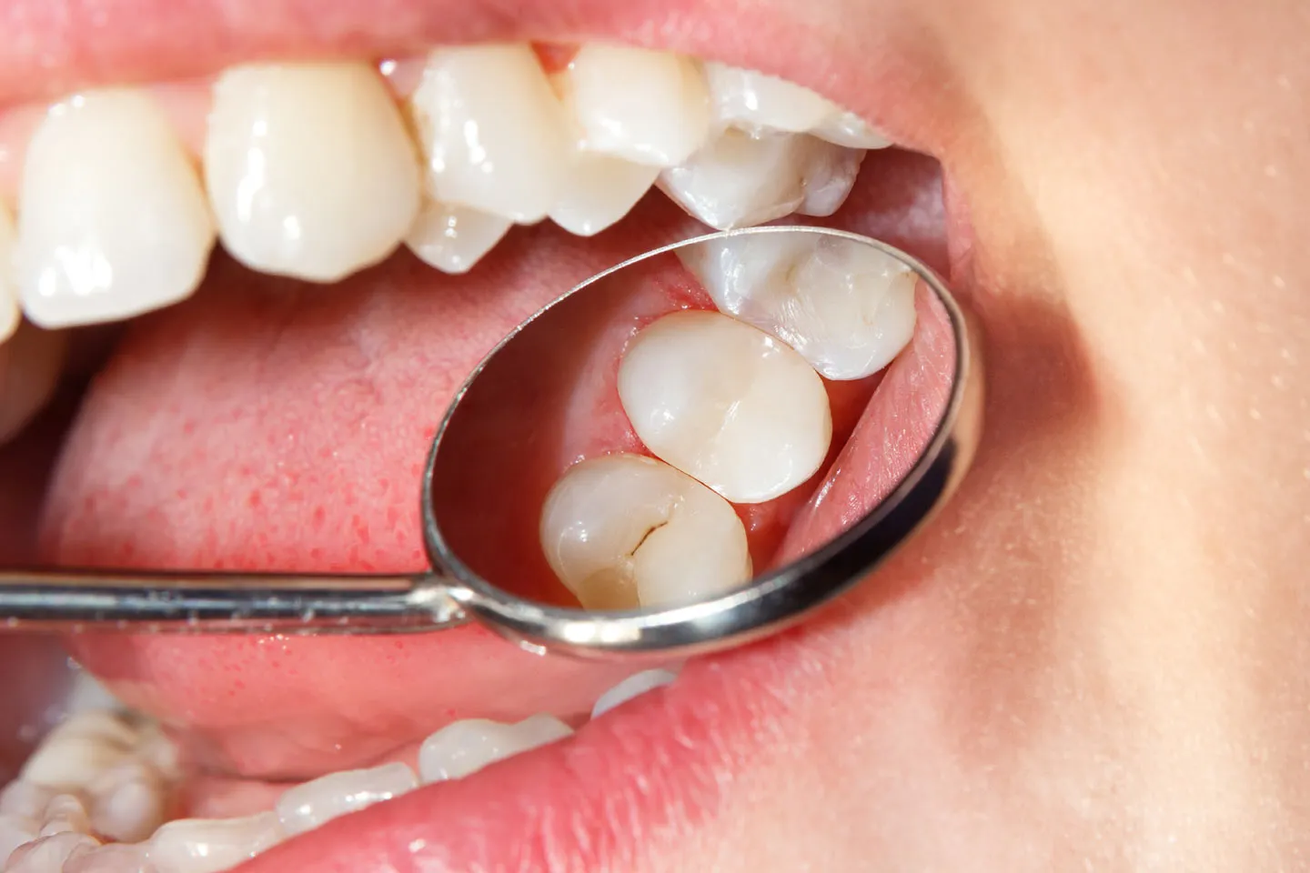 Dental Sealants