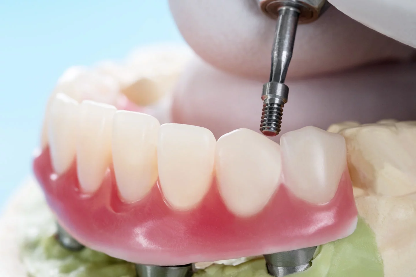 Implant Supported Dentures