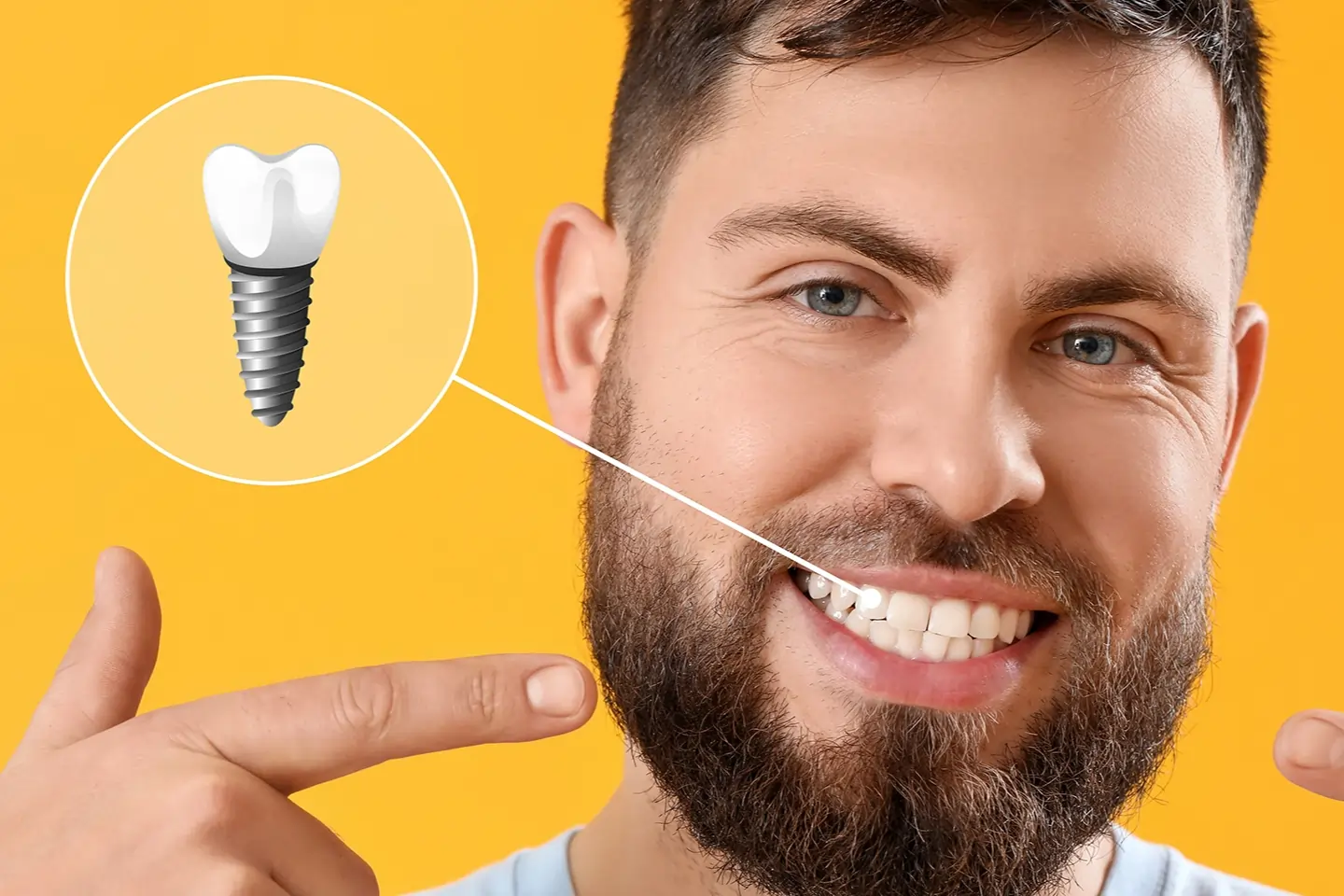 The Difference Between Dental Implants and Mini Dental Implants
