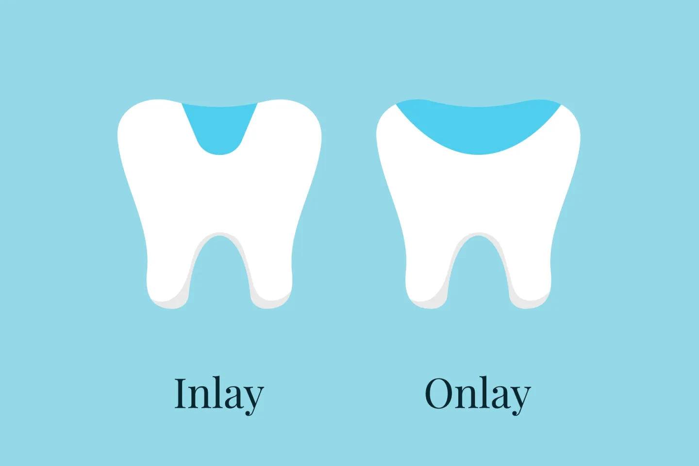 Dental Inlays and Onlays