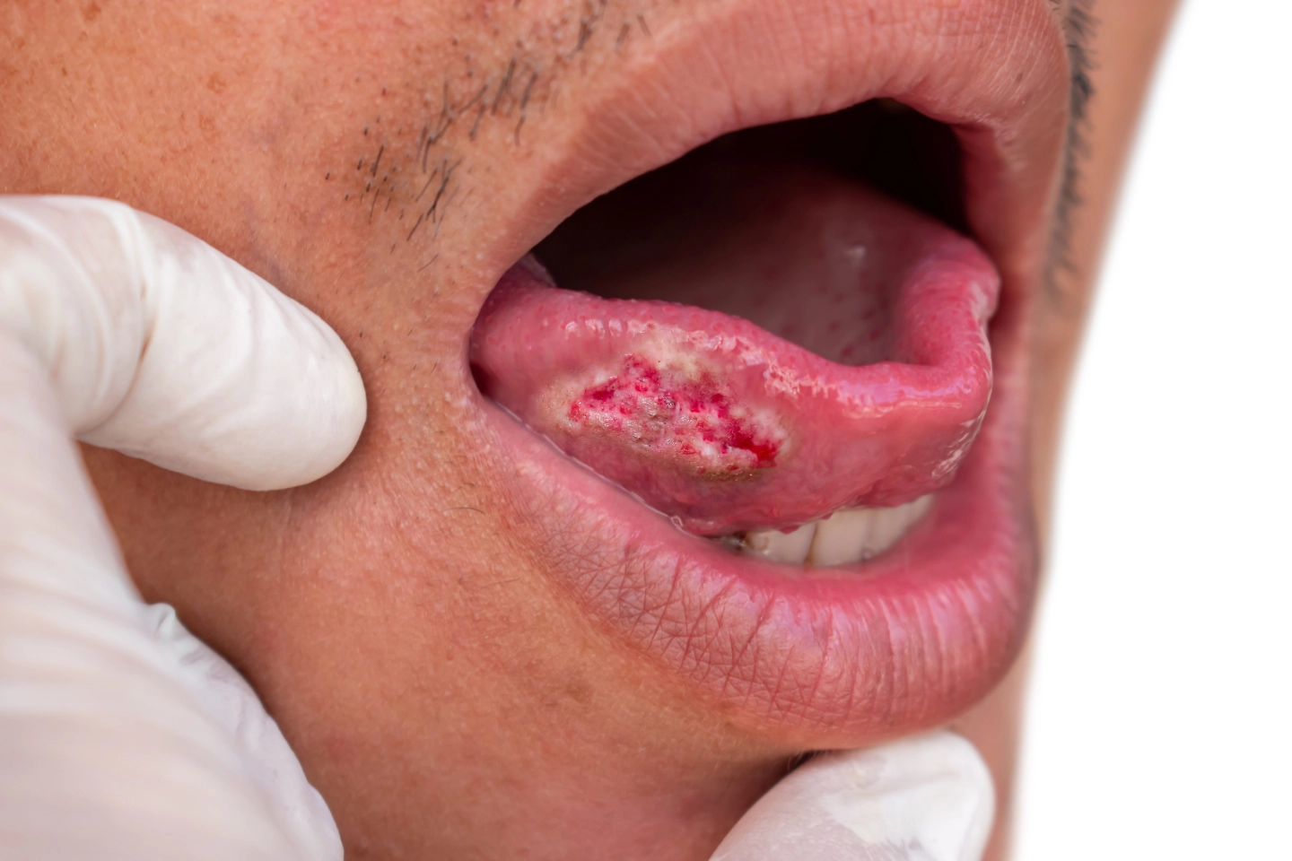 Oral Cancer Screening