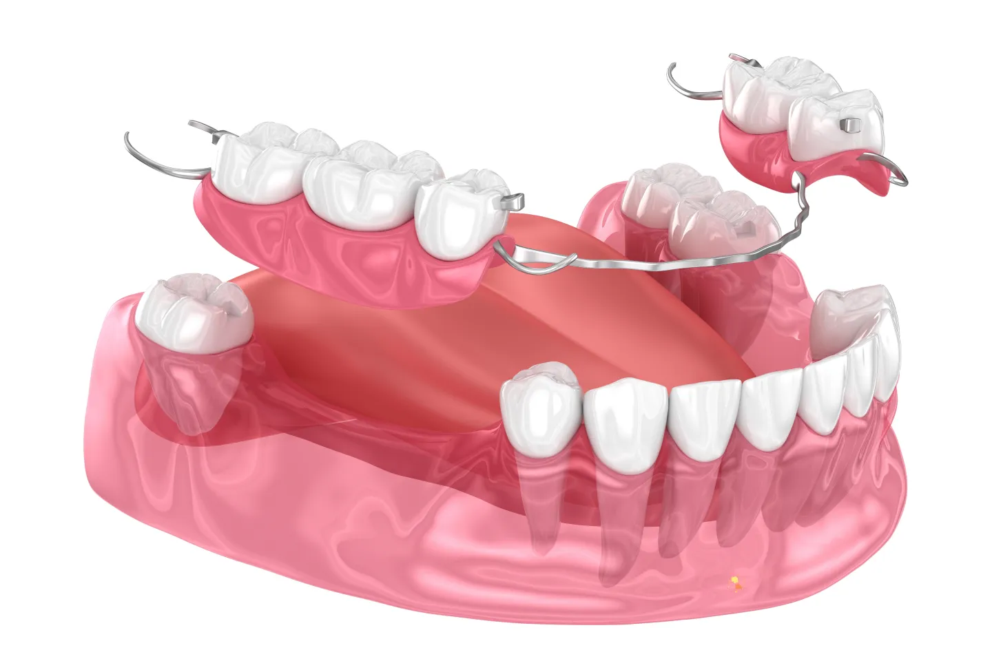 Partial Dentures for Back Teeth