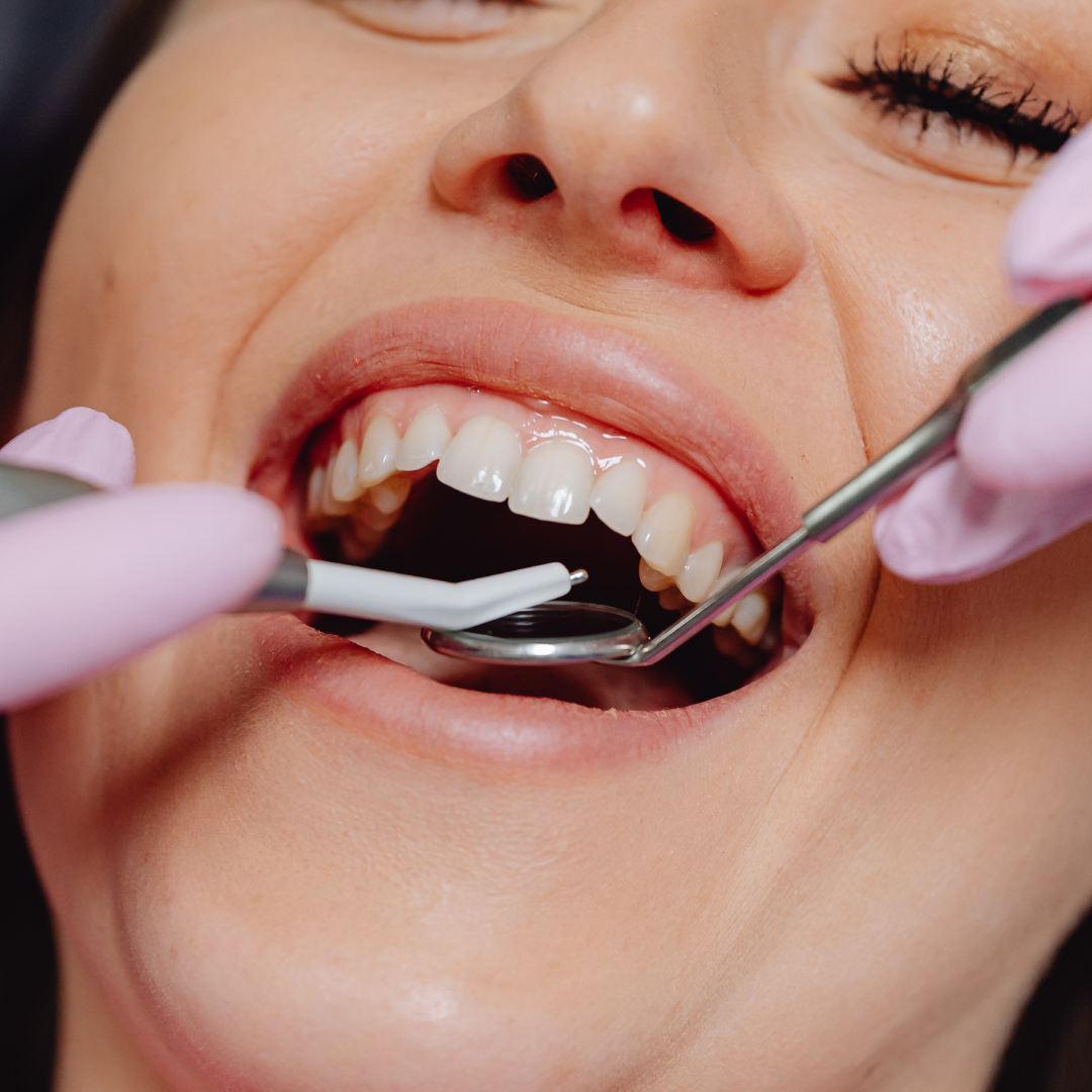 Dental Implants
