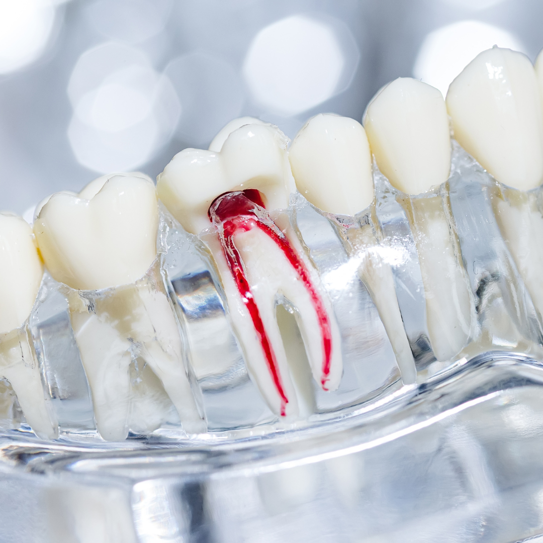 Root Canal Therapy