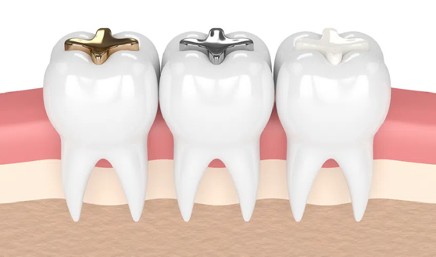 Dental Fillings