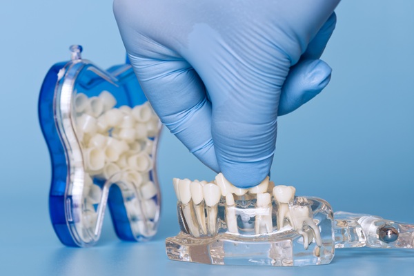 Implant Supported Dentures: What They Are And How They Work